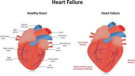 severe hypokinesis of left ventricle